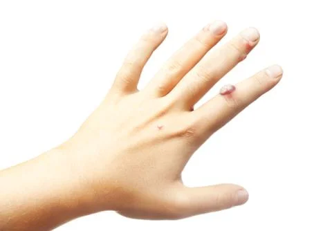 Hand with warts isolated on white background Stock Photos