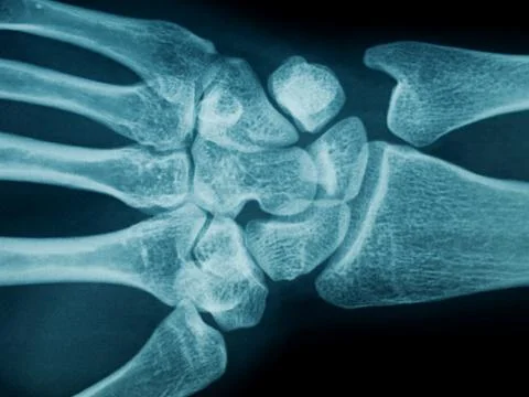 Hand wrist x-ray Stock Photos