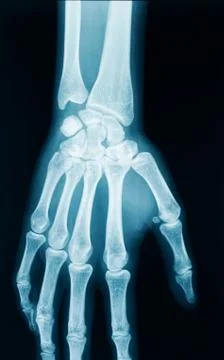 Hand x-ray Foto stock