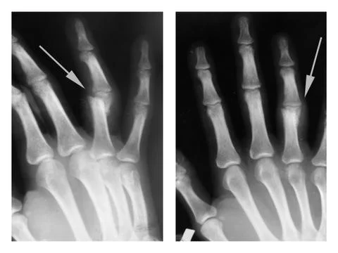 Hand,  X-ray Stock Photos