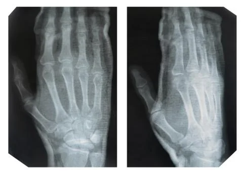 Hand,  X-ray Stock Photos