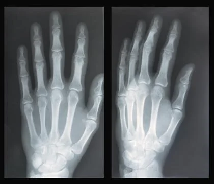 Hand,  X-ray Stock Photos