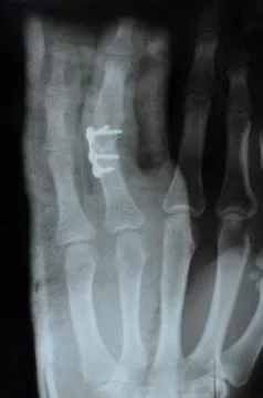 Hand,  X-ray Stock Photos