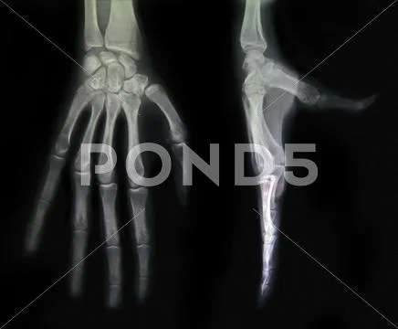 Hand x-rays Stock Photos
