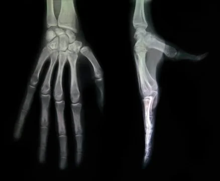 Hand x-rays Stock Photos