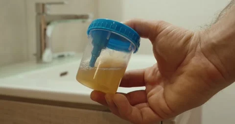 Handling Urine Sample Without Gloves – Hygiene Risk in Medical Testing 動画素材 334365095