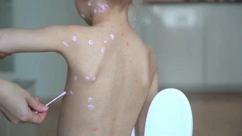 Hands applies ointment on back of sick girl with chickenpox. Skin rash treatment Stock Footage 233825072