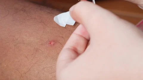 Hands applying a transparent adhesive dressing to a skin wound Stock-Footage 347588854