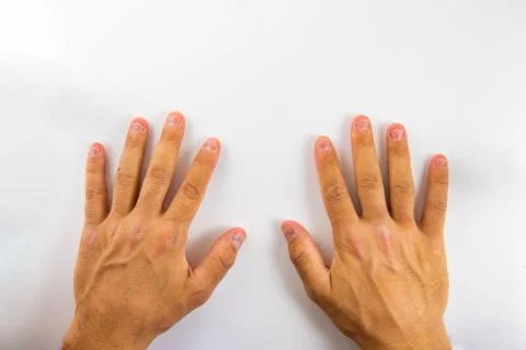 Hands with bitten nails on a white background Stock Photos