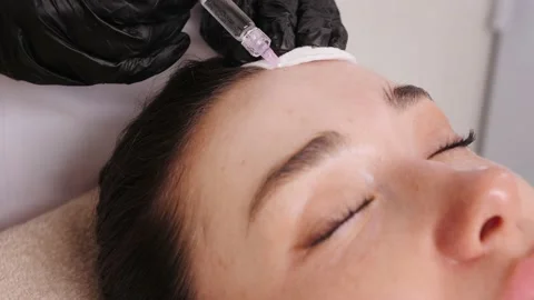 Hands in black gloves make injection in forehead closeup Stock Footage 196857919