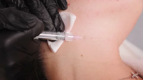 Hands in black gloves make point injections in neck closeup Stock Footage 197595707