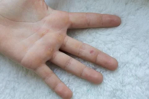 Hands blistered from the hard work of being an athlete. Stock Photos