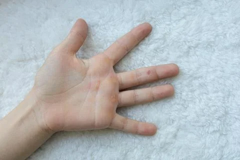 Hands blistered from the hard work of being an athlete. Stock Photos