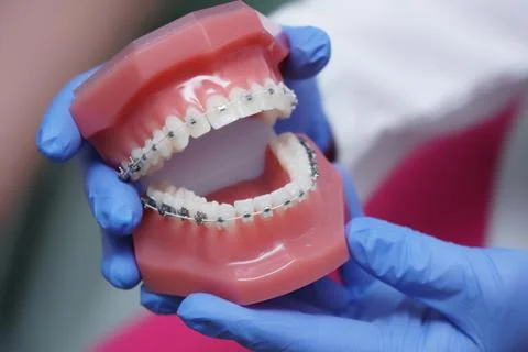 In hands on dentist orthodontics braces Stock Photos