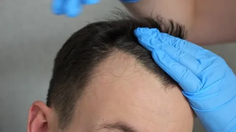 Hands of doctor in rubber gloves doing checkup of hair Stock Footage 221782341
