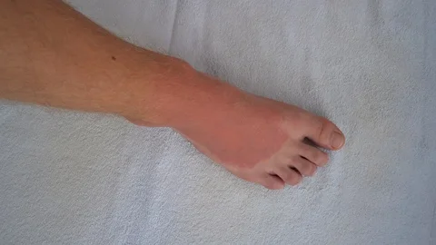 Hands Gently Touch Red Skin On Man's Sunburned Foot 4K Vidéo 96611820