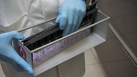 Hands in gloves are holding blood samples of the patient. biopsy the tissue. Stock-Footage 113685582