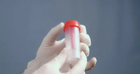 Hands hold a disposable container for collecting feces for tests. Video stock 169493301