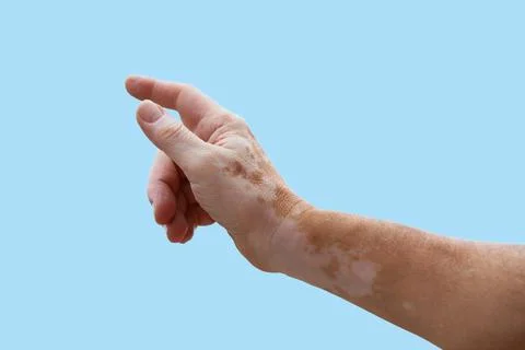 Hands Of A Man With Vitiligo Spots Stock Photos