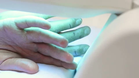 Hands of a patient with psoriasis close-up under an ultraviolet lamp. Stock-Footage 104408855