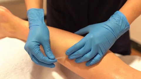 Hands of physiotherapist doing a dry needling Stock Footage 129587943