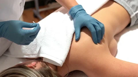 Hands of physiotherapist doing a dry needling Stock Footage 130522282