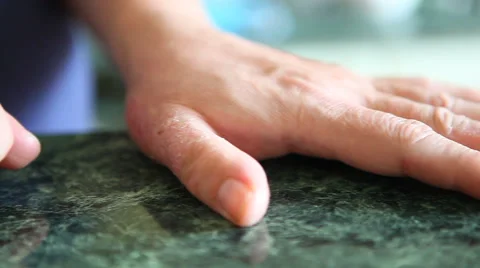Hands with psoriasis or shingles sickness. Skin problems. Stock Footage 63491310