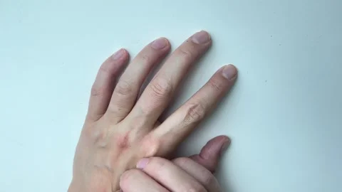 Hands scratching eczema allergy or dry skin for dermatology concept Stock Footage 338186352