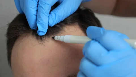Hands of specialist in gloves make marks on forehead of man Stock Footage 221844545
