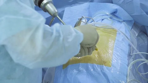 Hands of a surgeon inserting instrument Stock Footage 88636202