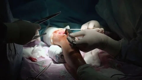 The hands of a Surgeon performing Knee Surgery Stock Footage 70873359