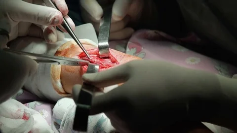 The hands of a Surgeon performing Knee Surgery, Close-up Stock Footage 70873896