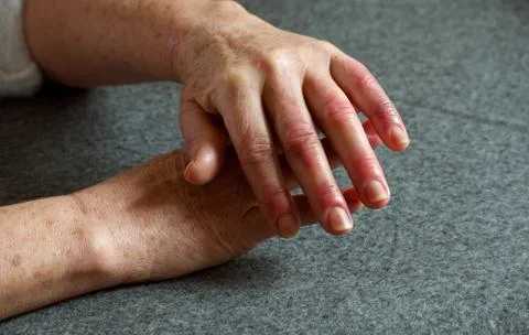 Hands of a woman with raynaud's syndrome, swollen and reddened fingers Stock Photos