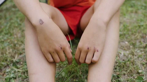 Hands of a young boy sitting on the grass on a summer day. Wounds on the hands Stock Footage 198353234