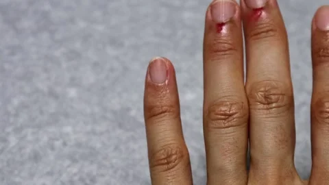 Hangnail finger video Vídeos de archivo 323499428