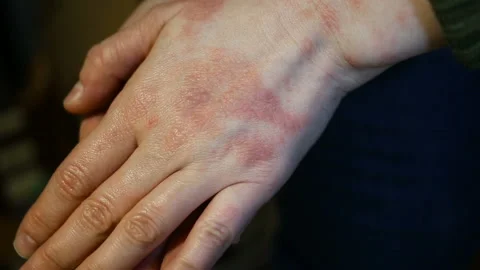 This Is Haphephobia. Allergic to human touch. From stress. Touch of human many y Stock Footage 128996917