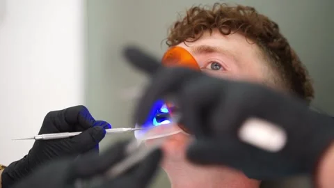 Hardening And Activating The Brackets Adhesive With Blue/Ultraviolet Light. Video stock 167303738