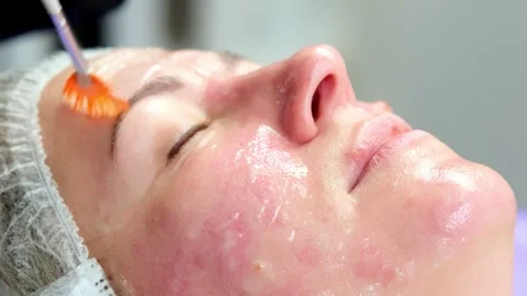 Hardware procedure in cosmetology. Stockbeeldmateriaal 263973473