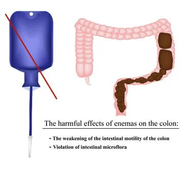 The harmful effects of enemas on the colon in constipation. Feces in the Stock Illustration