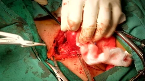 Harmonic Scalpel in Thyroid Surgery Stock Footage 131788940