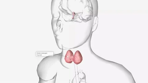 Hashimoto's thyroiditis is an autoimmune condition characterized by inadequate Stock Footage 231402209