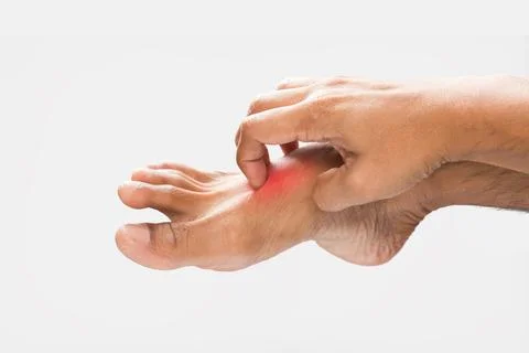Have a itching foot. Stock Photos