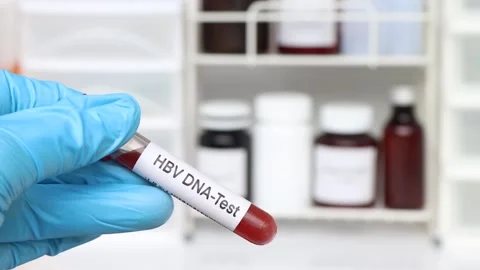 HBV DNA Test test to look for abnormalit... | Stock Video | Pond5