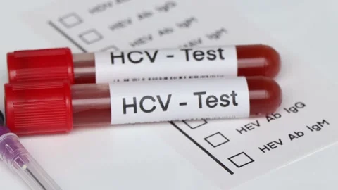HCV Test to look for abnormalities from ... | Stock Video | Pond5