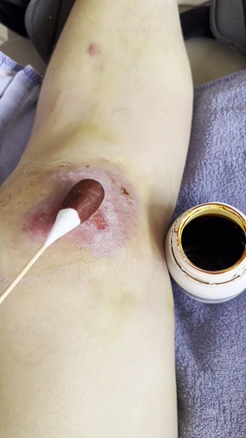 HD | 4K Applying Iodine Antiseptic To Knee Wound Stock Footage 338232006