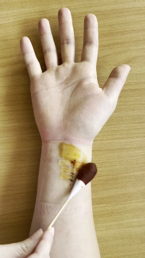 HD | 4K Applying Iodine To Stitched Wrist Wound Stock Footage 338232057