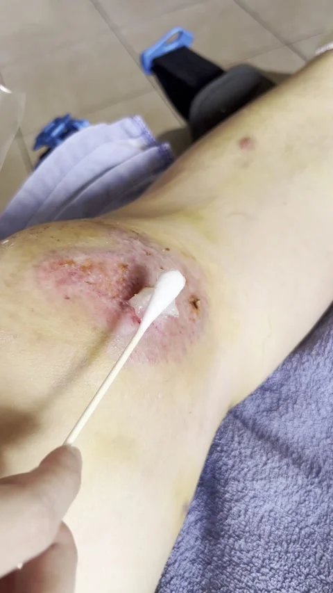 HD | 4K Close Up Knee Wound Care With Cotton Swab Stock Footage 338240867