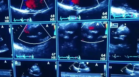 HD - echocardiogram live display wide shot slow zoom in Stock Footage 40049589