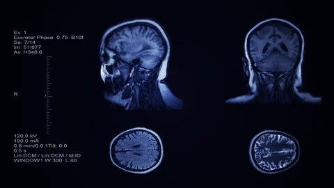 Head and brain computer tomography Stock Footage 125475992