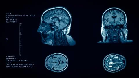 Head and brain computer tomography result Stock-Fotos
